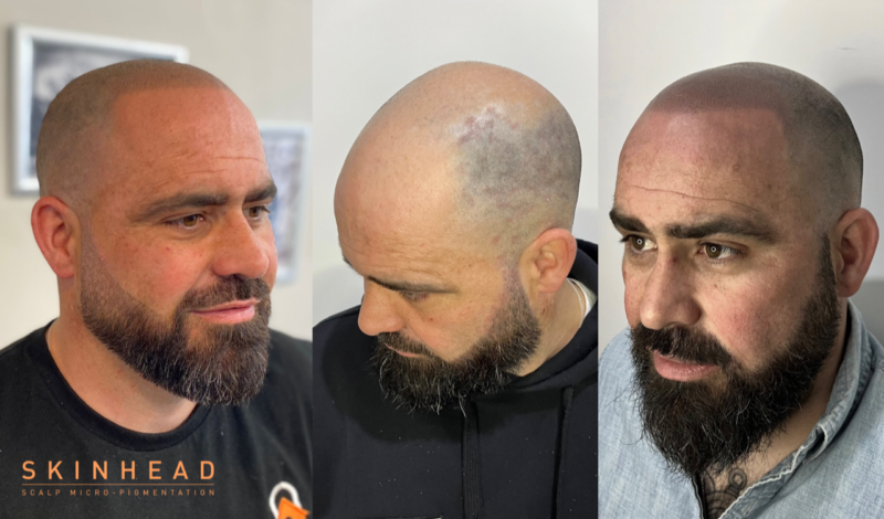 Skinhead SMP, Bury St Edmunds, Hair loss